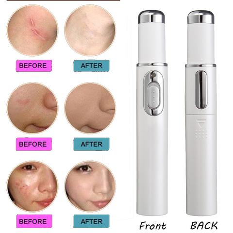 Laser Pen Soft Scar Wrinkle/Acne Removal Device