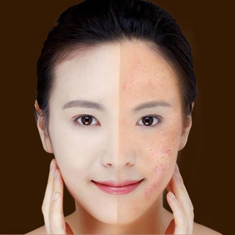 Laser Pen Soft Scar Wrinkle/Acne Removal Device